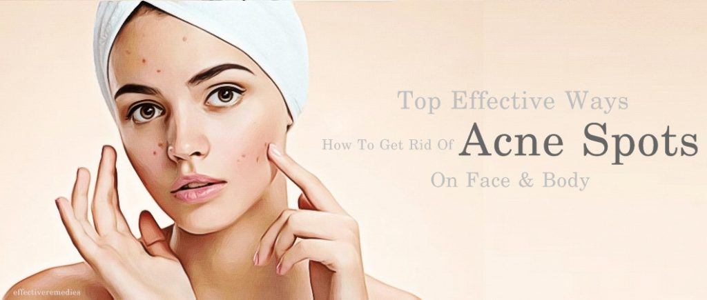 how to get rid of acne spots on face & body