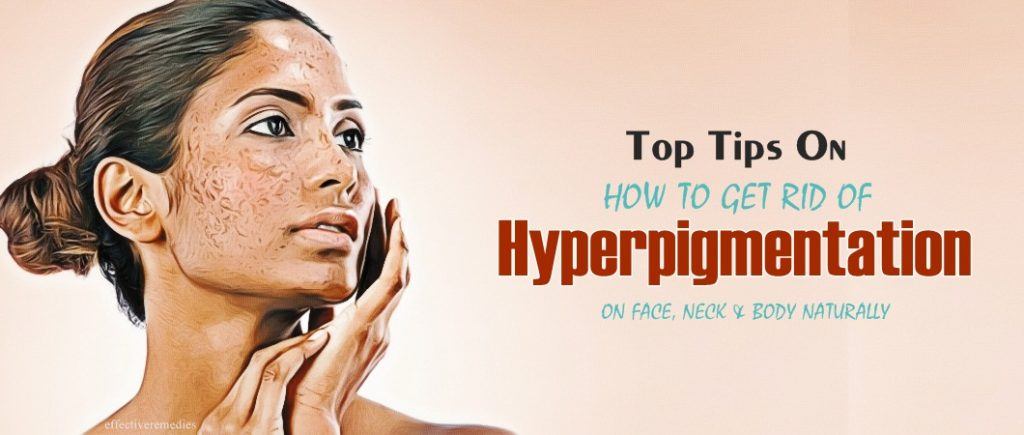 how to get rid of hyperpigmentation on face