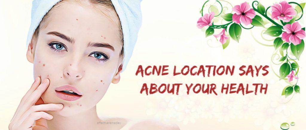 what your acne location says about your health and treatment