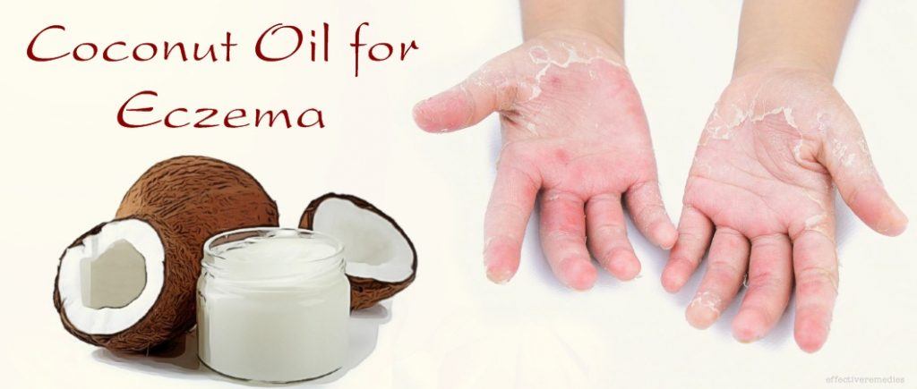 coconut oil for eczema on scalp