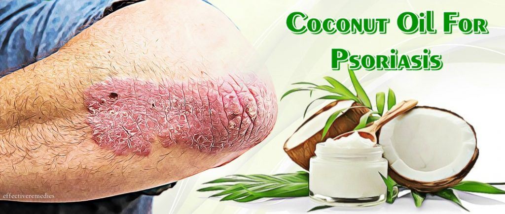 coconut oil for psoriasis on scalp