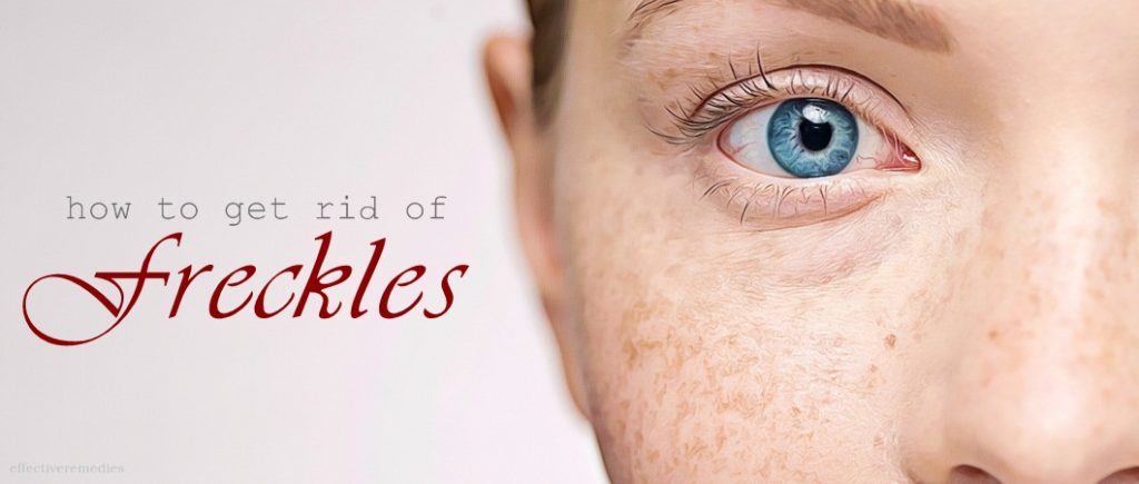 how to get rid of freckles on shoulders