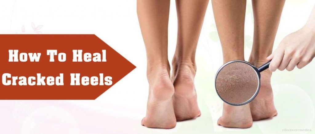 how to heal cracked heels naturally